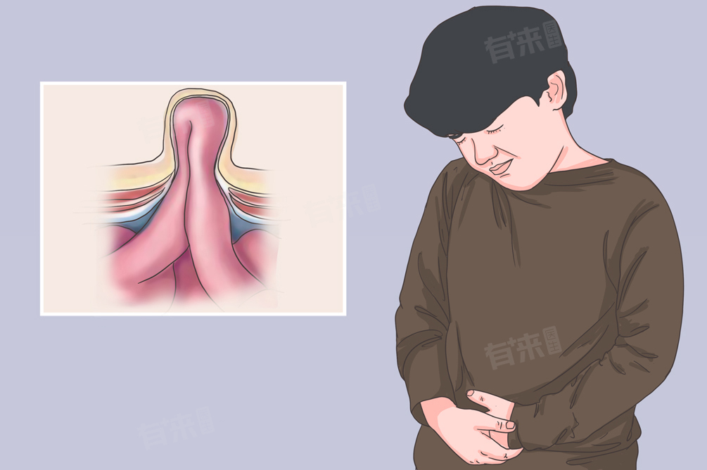 脐疝形成的原因